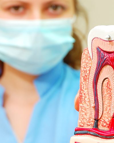tratamiento del nervio dental o root canal