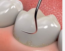 proxilasis o limpieza dental profunda en Houston, Texas