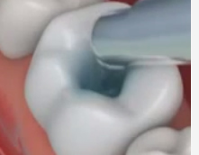tratamientos de endodoncia en Houston, Texas