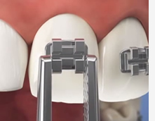 frenillos, frenos dentales, braces, brackets en Houston, Texas