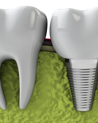implantes dentales en houston, texas