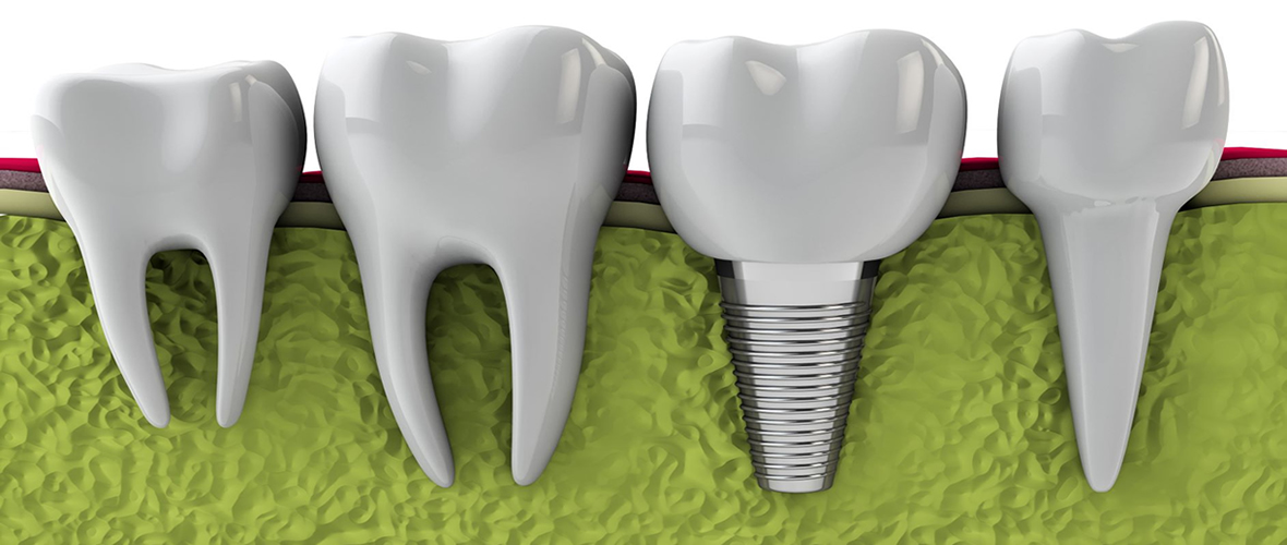 implantes dentales en houston, texas