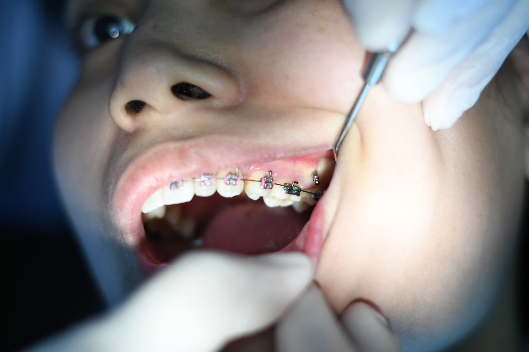 ¿Cuál es el momento correcto para ver a un ortodoncista?