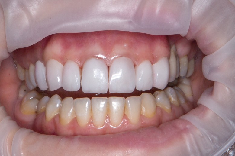 Reasons Why You Should Go For Teeth Whitening
