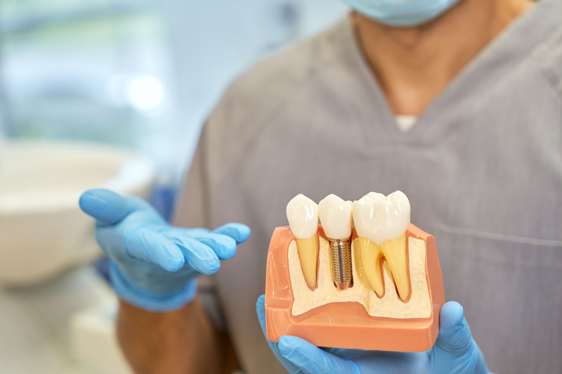¿Se Pueden Tener Implantes Dentales Con Pérdida Ósea Severa?