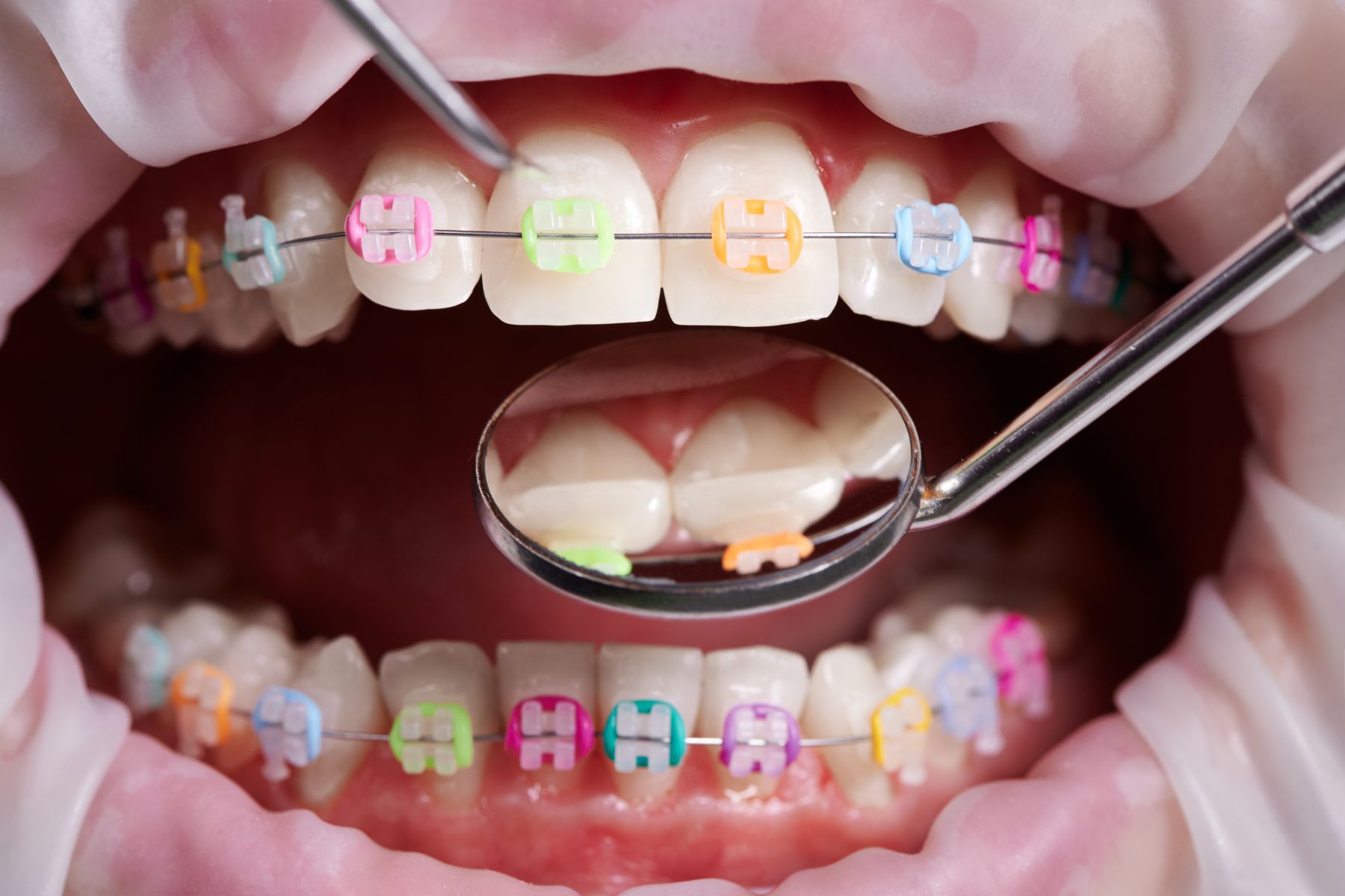 Choosing Between Clear Aligner Braces and Traditional Braces: Which Option is Best for You?